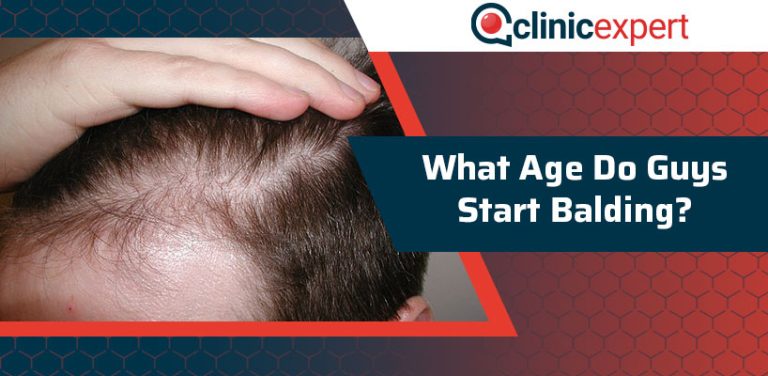 What Age Do Men Start Balding?