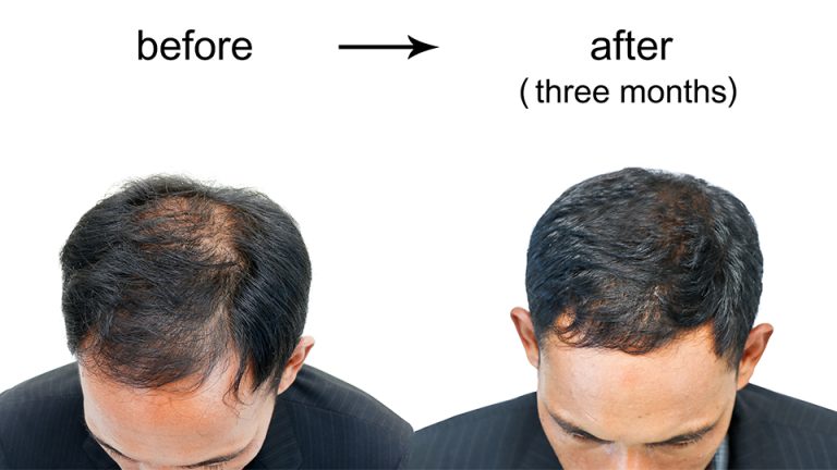 Why Is Baldness Increasing?